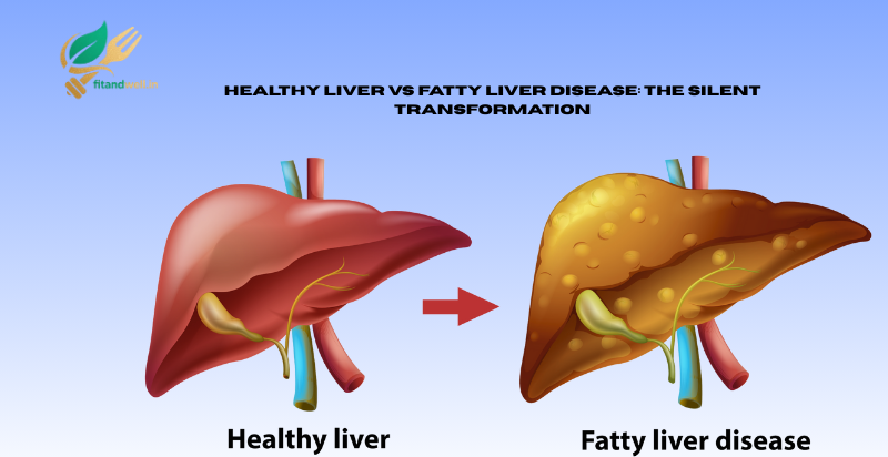 Read more about the article What Is Excess Fat Buildup in the Liver: Fatty Liver Disease